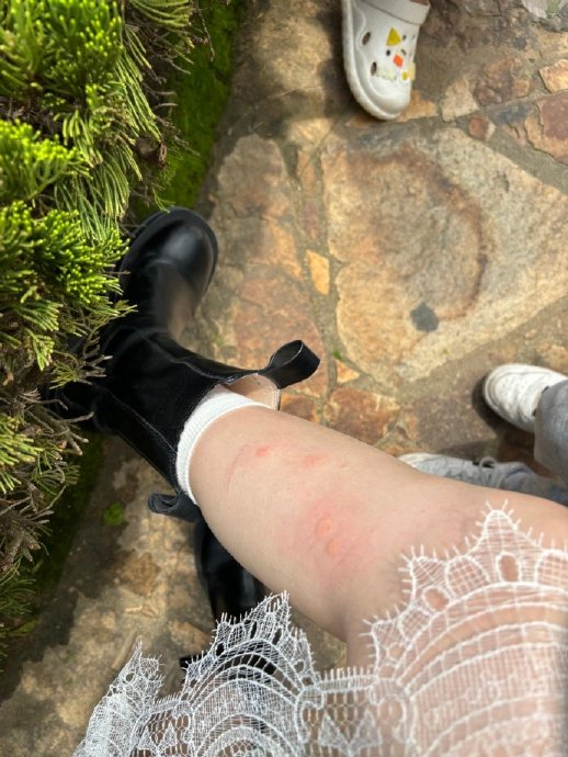 福建蚊子彻底疯狂|蚊子|咬人|大包_新浪新闻