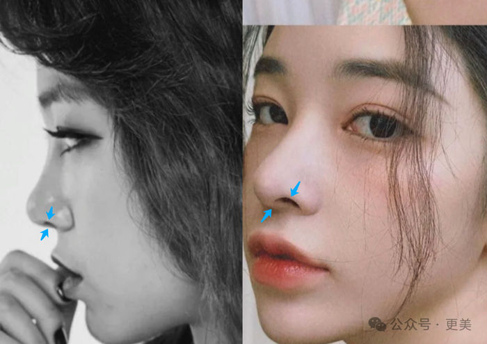 同时下移假体假体,给山根留出喘息空间,这是当下流行「塌鼻梁」的