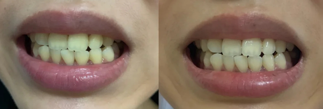 经白桦脂醇与口腔中的酶结合,快速产生氧化还原反应,胜过冷光镁白