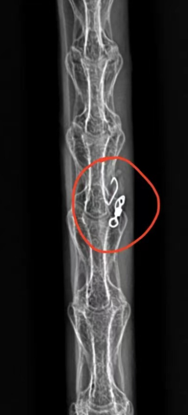 爱宝食管中的鱼钩