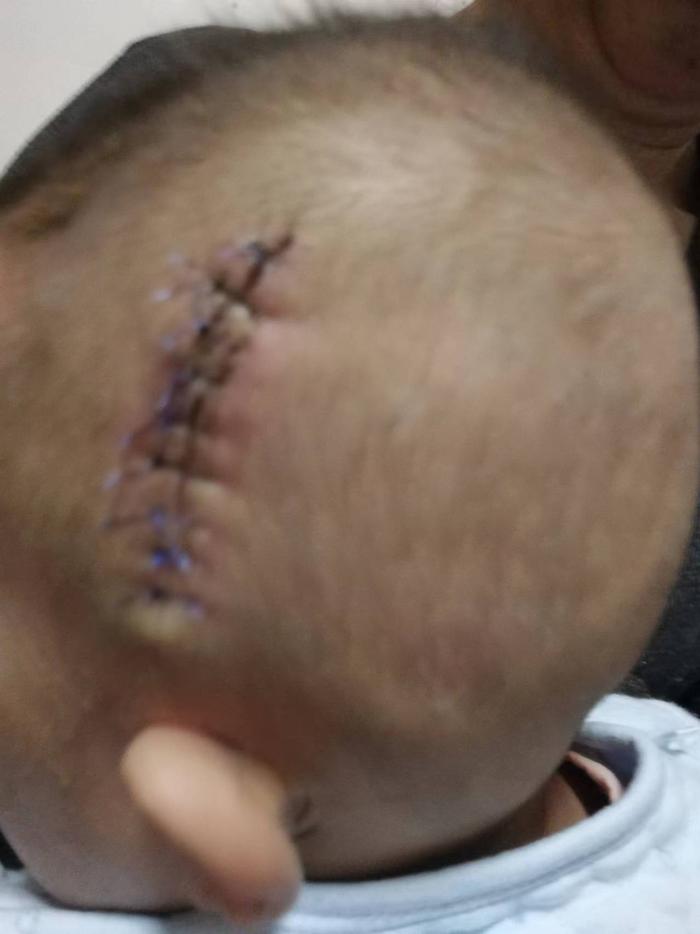 2018年12月30日，小白在西安市儿童医院进行取出手术，手术失败后在头上留下的伤口。 受访者供图