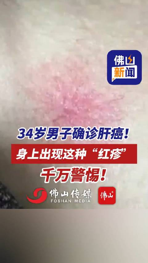 34岁男子确诊肝癌!注意:身上出现这种"红疹",千万警惕!