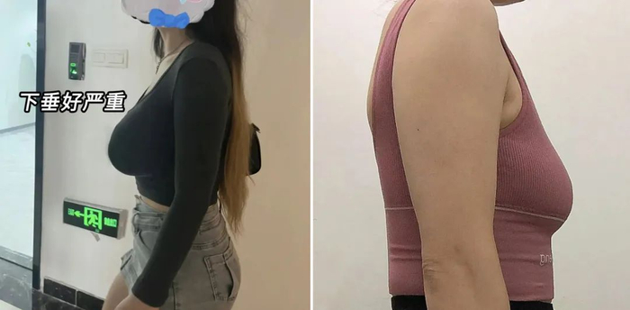 运动时"抖胸"会让胸部下垂不可逆?运动内衣真的要穿专业的才行!