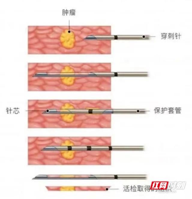 穿刺活检还你针相大白