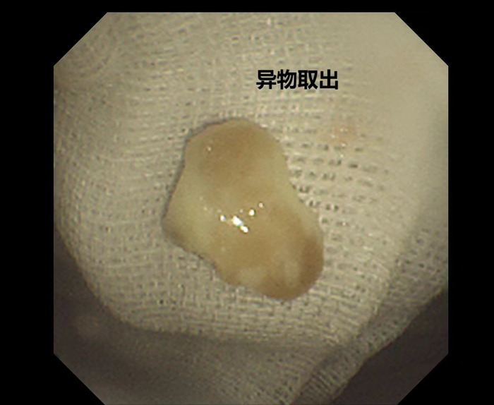 异物被放置在纱布上,医生们惊讶发现,竟是半粒花生米.