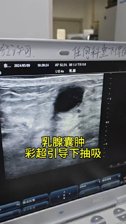 彩超引导下抽吸乳腺囊肿