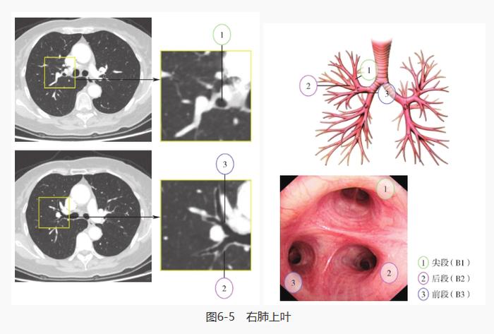 左肺下叶后基底段图片图片