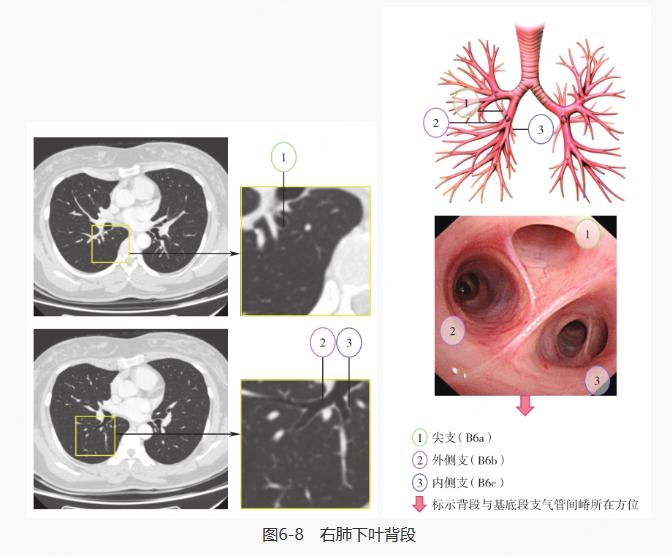 右肺上叶尖段图片