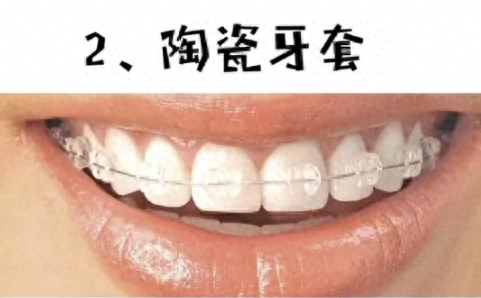 陶瓷材质的颜色与牙齿的自然色相近,因此佩戴后几乎不易被察觉,为患者