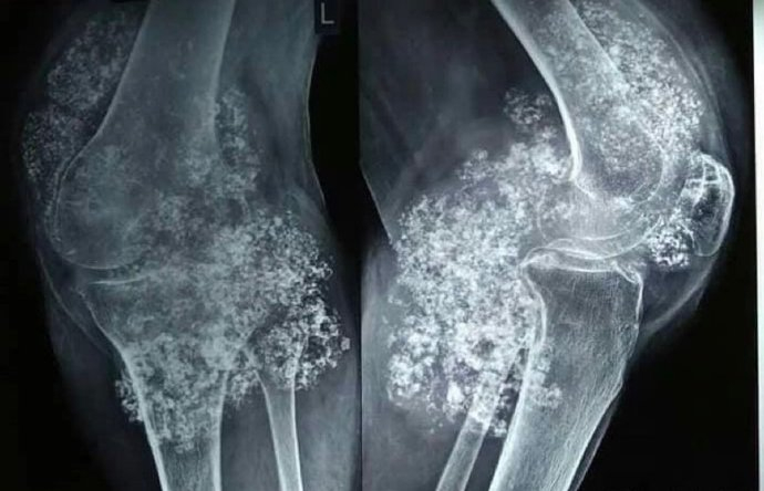 滑膜软骨瘤病也称为滑膜骨软骨瘤病