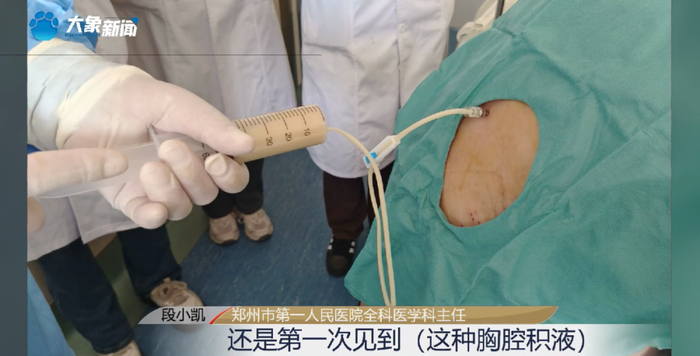 小伙每天喝两千五百毫升奶茶,胸腔抽出奶茶色积液