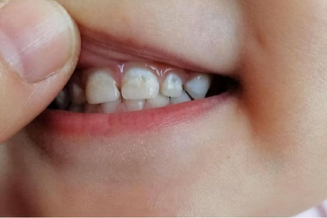 如何预防幼儿牙齿钙化?