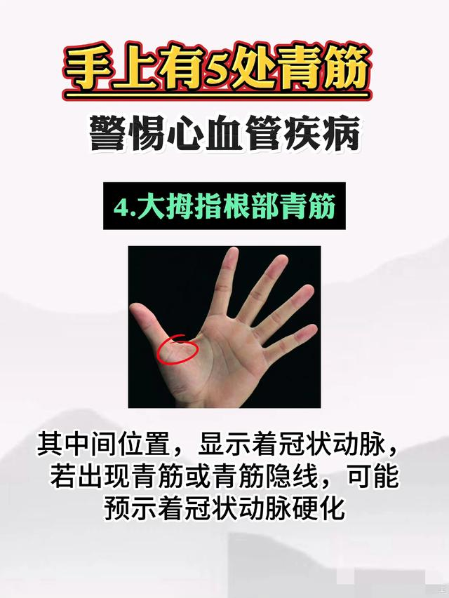 手上五处青筋,警惕心血管疾病
