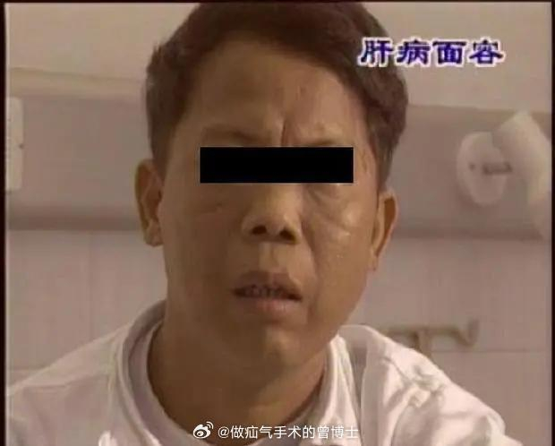 肝病面容,患者面部皮肤色泽逐渐变暗,脸色发黑,没有光泽弹性差