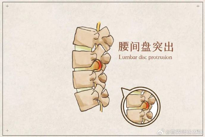 哪些原因会导致"腰间盘突出"?