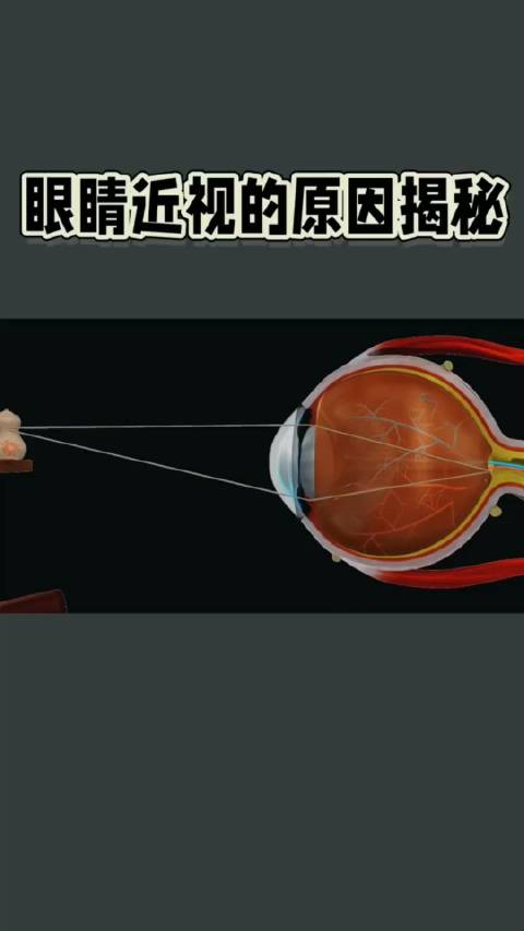近视眼为啥看不清?一分钟搞懂