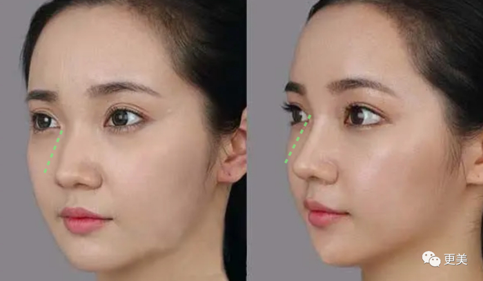 低配版虞书欣的鼻子,整得比鞠婧祎还成功!