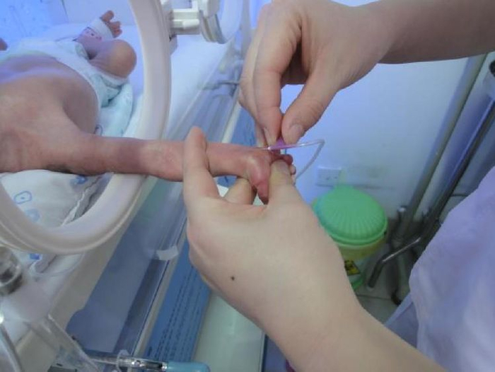 新生儿桡动脉穿刺在护理临床工作中的应用