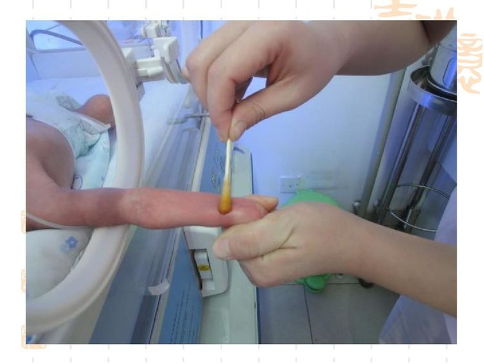 新生儿桡动脉穿刺在护理临床工作中的应用|血管|针头_新浪新闻