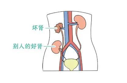 移植肾的位置图片图片