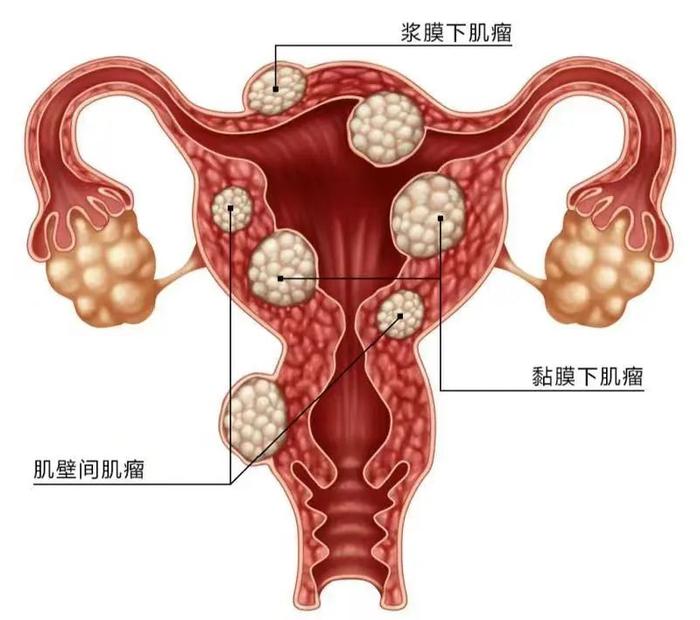 求助:我排出了子宫形状的内膜,是怎么回事?