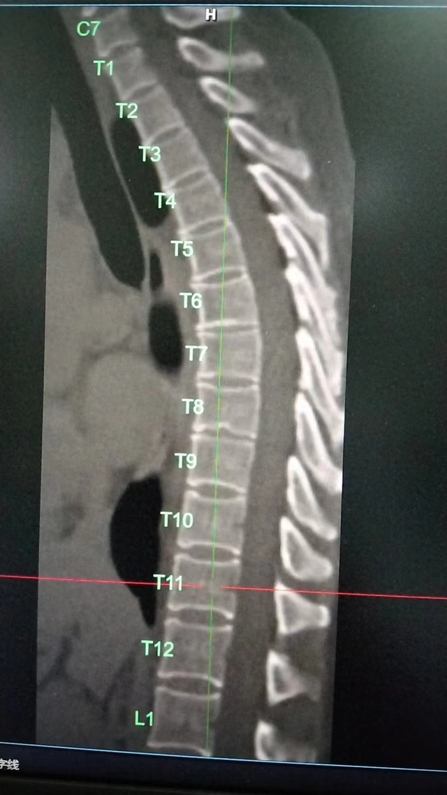 在医疗技术日新月异的今天,骨密度检查作为评估骨骼健康的重要手段