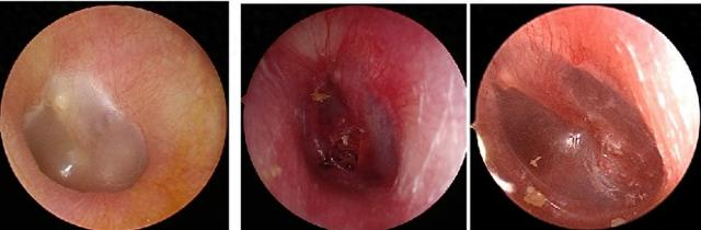 情侣亲吻耳朵,鼓膜竟被嘬破!