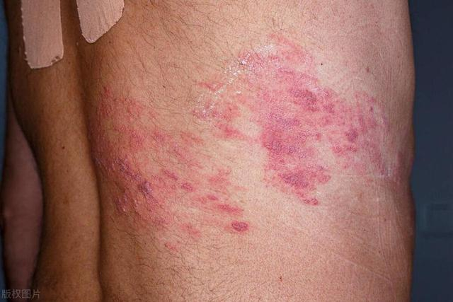 有一种剧痛叫"带状疱疹",用什么药好得快?这4类人要|_