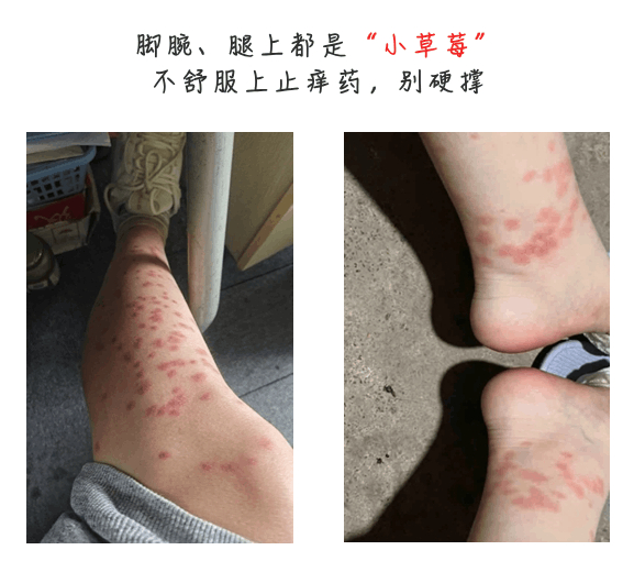 头痛,恶心,呕吐,意识障碍等严重症状,要及时就医,告知医生蠓虫叮咬史 