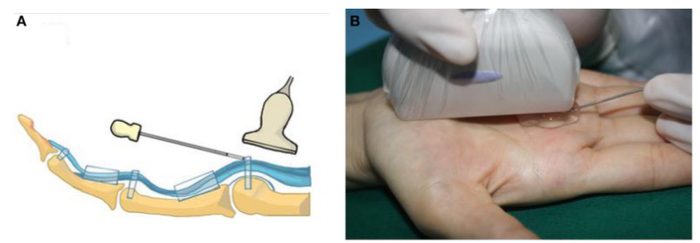 新闻科普 | 腱鞘炎"困"住手指 超声可视化小针刀轻巧化解