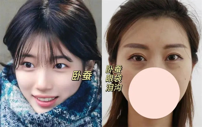 卧蚕|眼袋|轮匝肌_新浪新闻