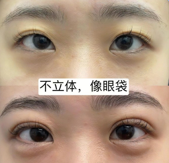 卧蚕|眼袋|轮匝肌_新浪新闻