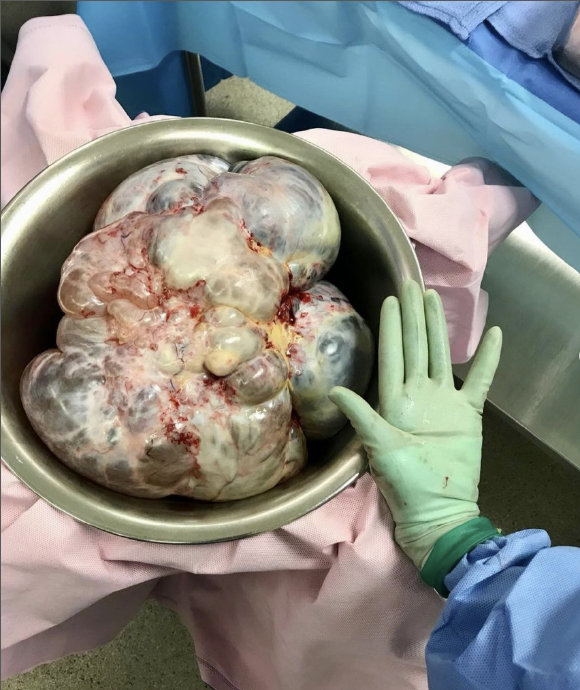 卵巢粘液性囊腺瘤 它属于含粘蛋白上皮性卵巢肿瘤的良性肿块