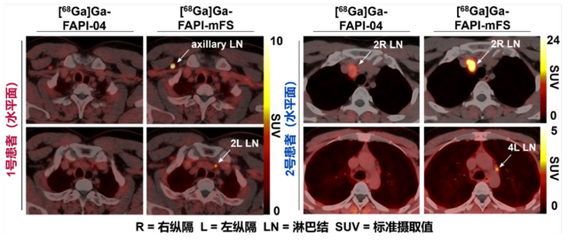图2 靶向共价放射性药物在癌症病人中灵敏度高，可以发现现有技术难以诊断的肿瘤病灶