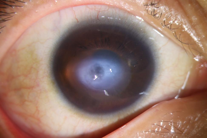 24岁小伙患上了一种角膜病,视力两月内直线下降几失明