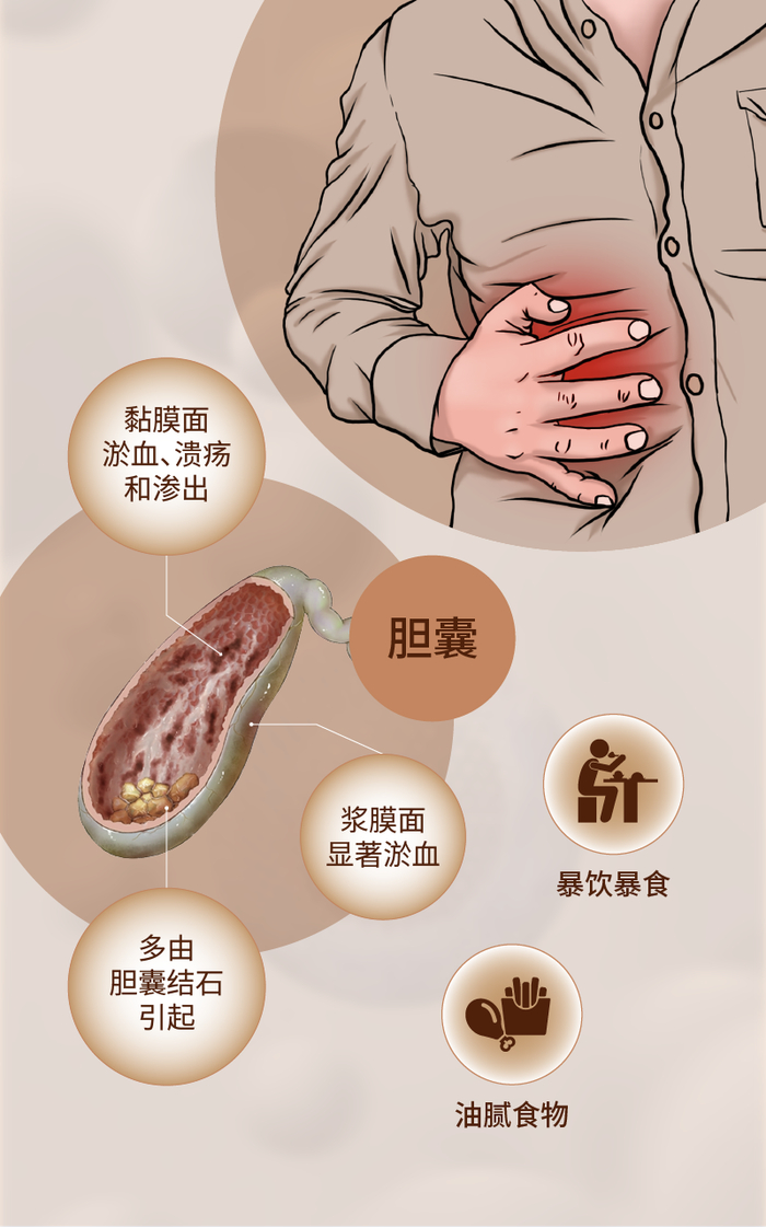 科普|急性胆囊炎怎么治,如何防?