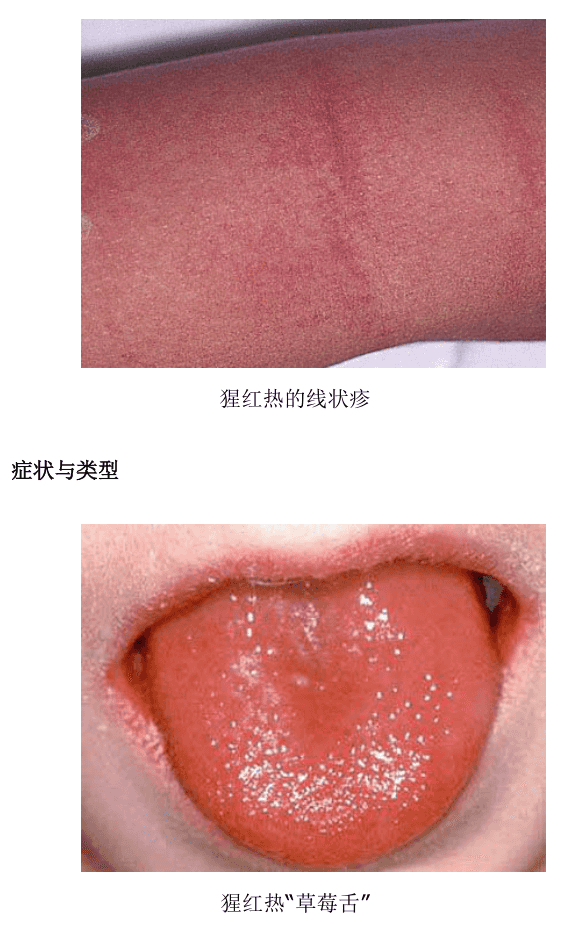 多地有人确诊|猩红热|感染|发热_新浪新闻