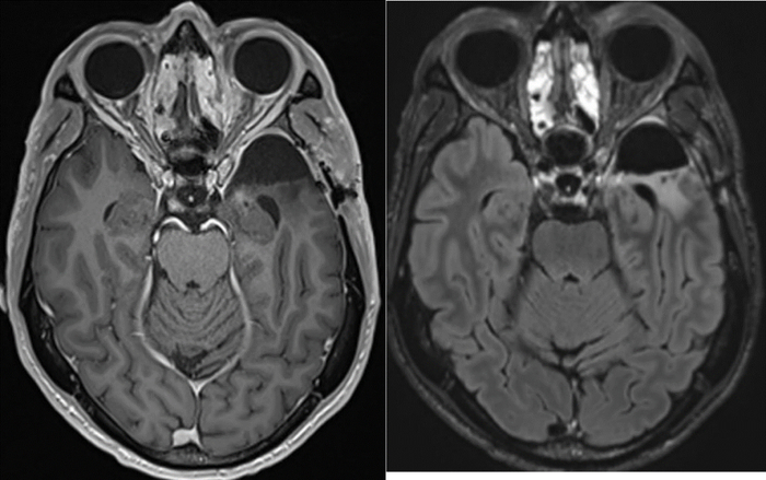 2024年3月19日，理查德·斯科莱尔在个人社交媒体发布了治疗10个月后的脑部复查结果。/Richard Scolyer