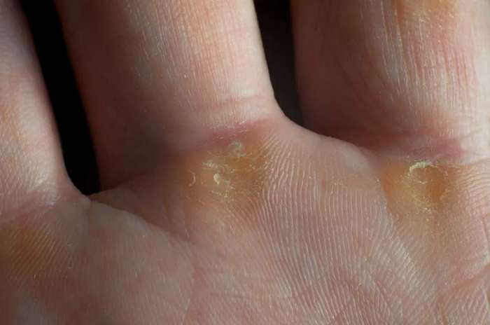 "鸡眼"偏爱这4种人,你中招了吗?