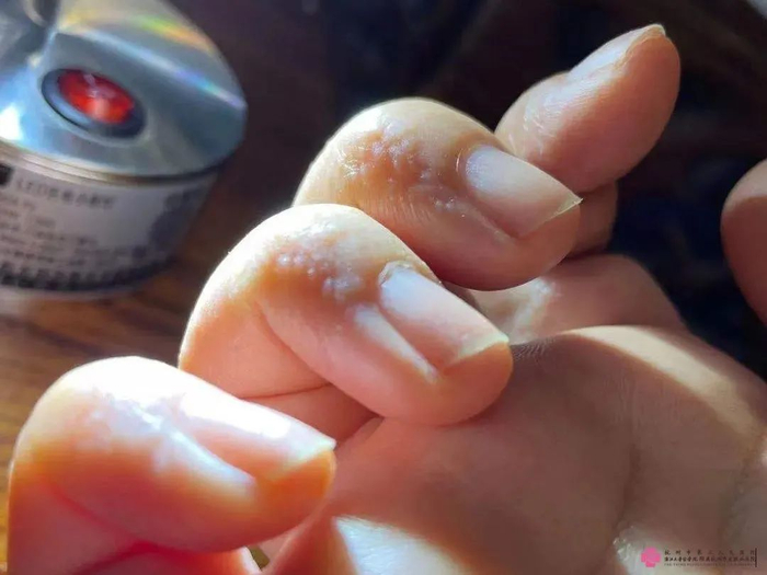 汗疱疹|水疱|软膏_新浪新闻