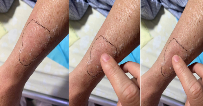 拔针后6小时发生迟发性静脉炎,输注这种药物需警惕!
