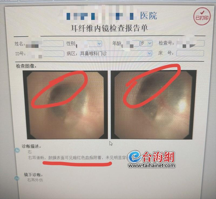 右耳被技师弄伤,去医院检查发现右耳右鼓膜