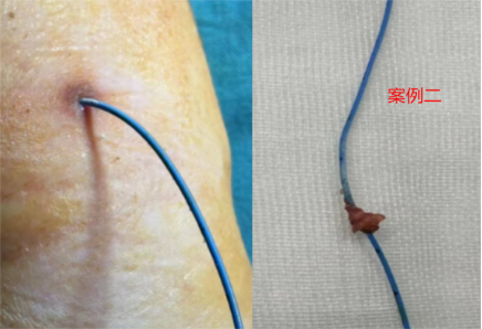2例小儿患者picc导管拔除困难案例分享