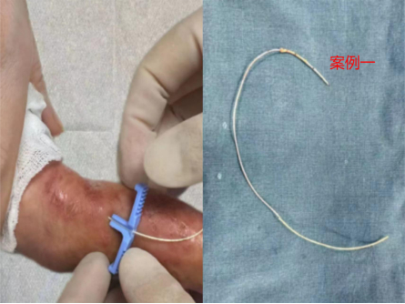 2例小儿患者picc导管拔除困难案例分享