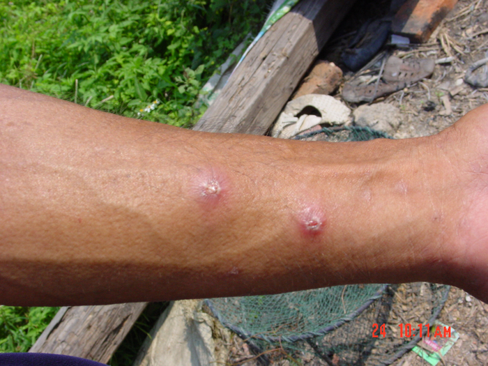 人被红火蚁叮咬后，手上留下的红肿脓包。受访者供图