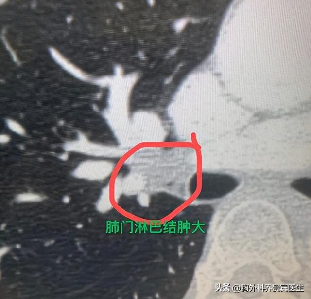 肺癌一旦出现淋巴结转移,就是晚期了吗?
