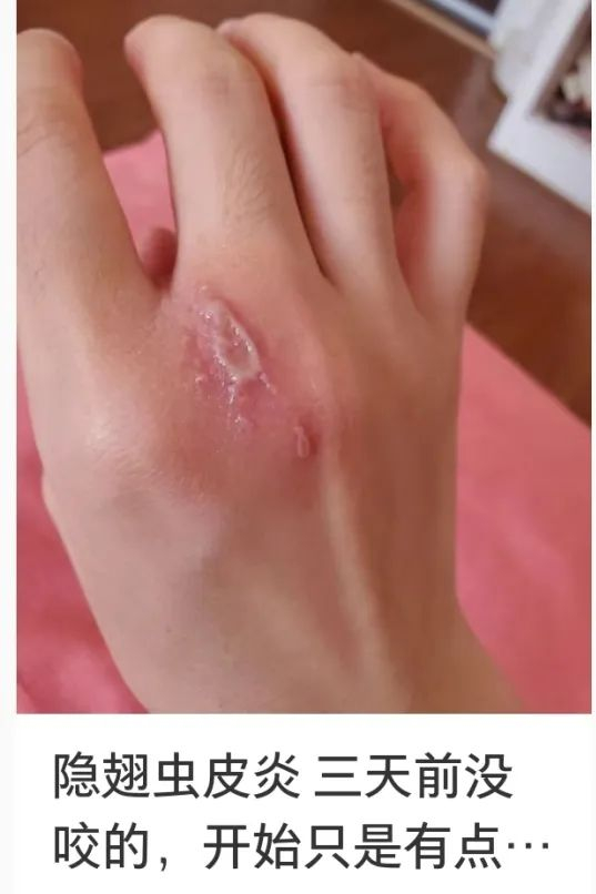 来看看网友们的悲惨经历毒液沾染在皮肤局部,或由拍虫子的手触摸到