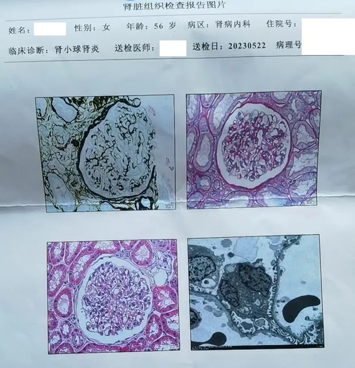 50多岁查出遗传性肾病,ckd3期!改变不了疾病,那就改变自己