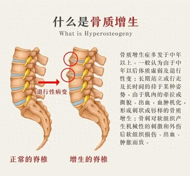 止痉散治疗骨质增生病