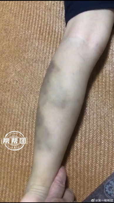 孩子"全托"在熟人机构,小腿肚被打淤青,爷爷讨说法却被儿子反对